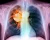 Istituito il Pdta per il tumore del polmone